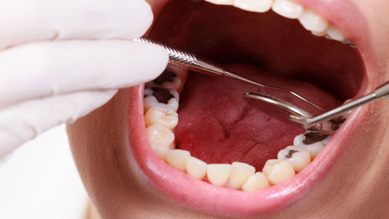 An Office for Family Dentistry in Fairfax Talks About Fillings Falling Out