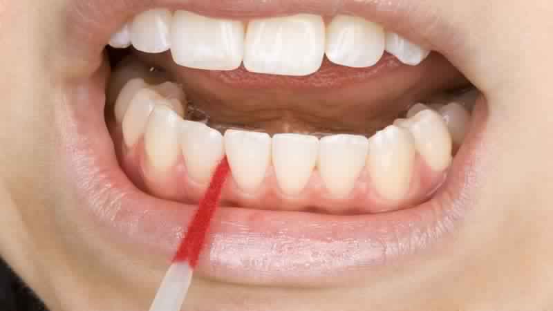The Advantages of Wearing Invisalign in Franklin to Straighten Teeth