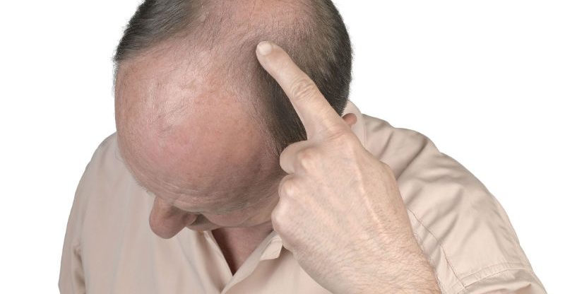 How to Improve Crown Hair Loss with Hair Transplant in New York City