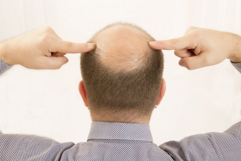 Factors to Consider Before Deciding to Get a Hair Transplant in NJ
