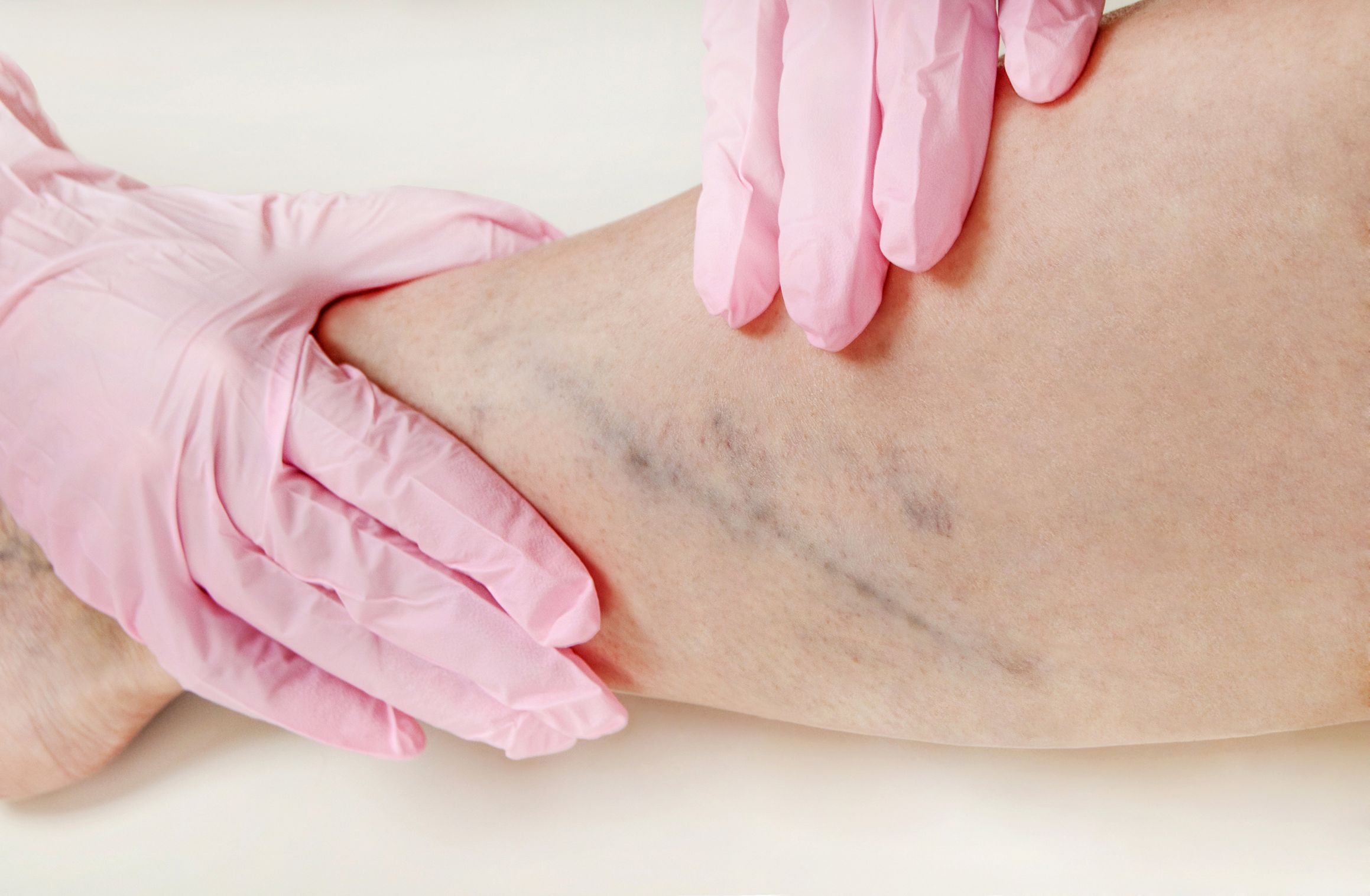 Understanding Sclerotherapy in Bucks County, PA