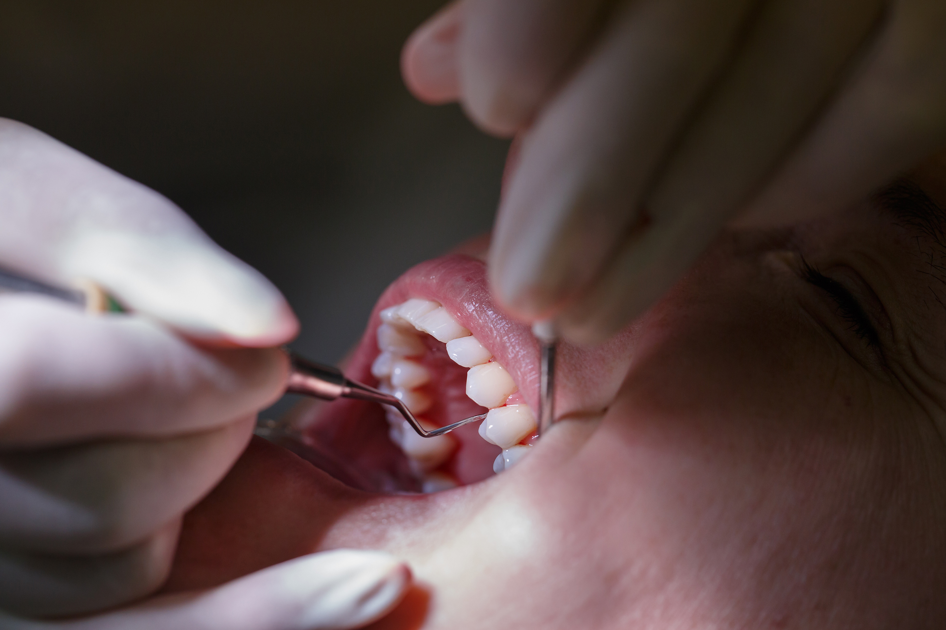 The Role Of Dental Crowns in Bend, OR, For Oral Health