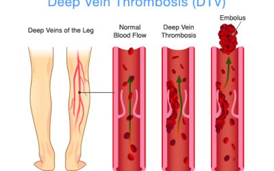 Recognizing Changes Linked to Deep Vein Thrombosis in Virginia Beach, VA, for Early Intervention