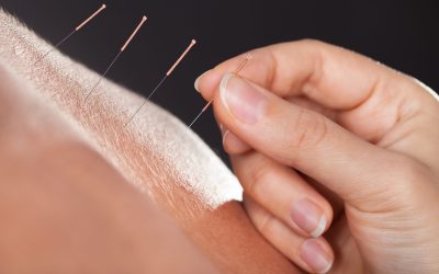 Unlocking Natural Pathways to Parenthood with Fertility Acupuncture in Burbank, CA